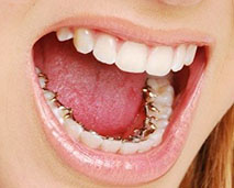 Lingual Braces  Greater Vancouver Orthodontics