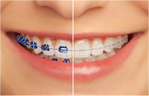 Clear or Invisible braces  What they are and types 🦷